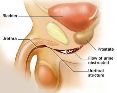 Urethral Stricture