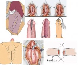 Treatment of urethral stricture